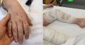 Врачи достали из тела мальчика, пострадавшего во время пострадавшего во время удара дрона ВСУ по дому в Подмосковье, все бетонные осколки и обработали раны