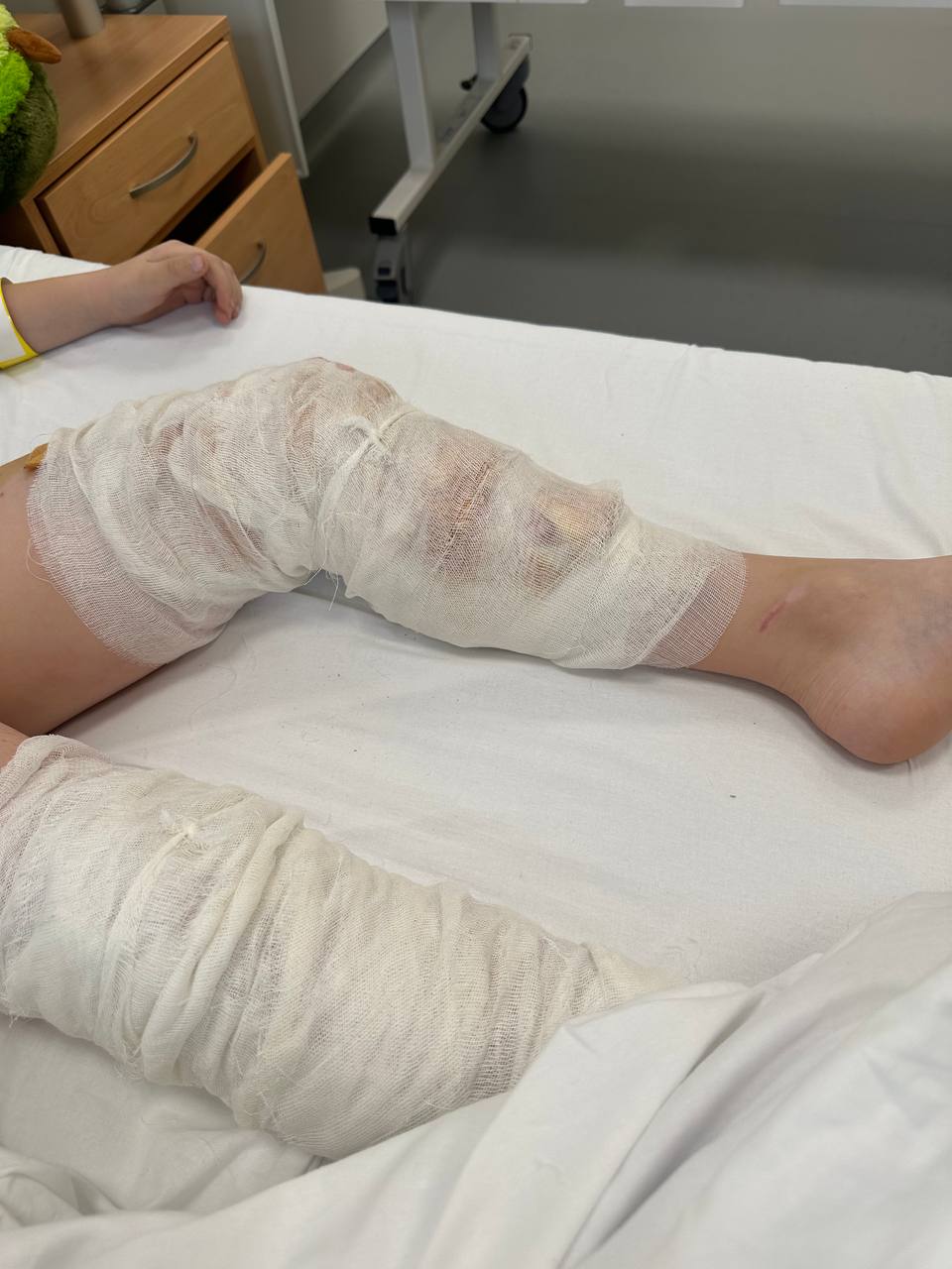 Врачи достали из тела мальчика, пострадавшего во время удара дрона ВСУ по дому в Подмосковье, все бетонные осколки и обработали раны Врачи достали из тела мальчика, пострадавшего во время удара дрона ВСУ по дому в Подмосковье, все бетонные осколки и обработали раны