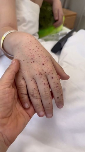Врачи достали из тела мальчика, пострадавшего во время удара дрона ВСУ по дому в Подмосковье, все бетонные осколки и обработали раны