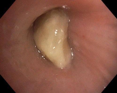 Врачи Центра Рошаля достали орех из бронха годовалого малыша Врачи Центра Рошаля достали орех из бронха годовалого малыша