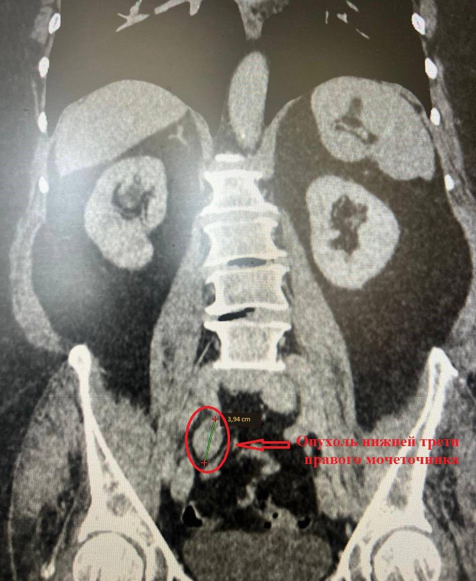 Коломенские врачи спасли почку женщине с опухолью Коломенские врачи спасли почку женщине с опухолью
