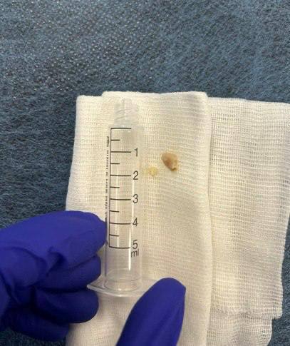 Врачи Центра Рошаля достали орех из бронха годовалого малыша Врачи Центра Рошаля достали орех из бронха годовалого малыша