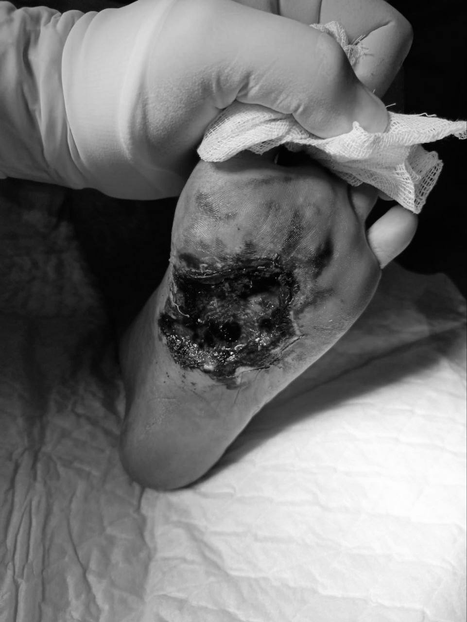 Подмосковье: врачи спасли ногу подростку после ДТП