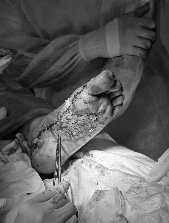 Подмосковье: врачи спасли ногу подростку после ДТП Подмосковье: врачи спасли ногу подростку после ДТП