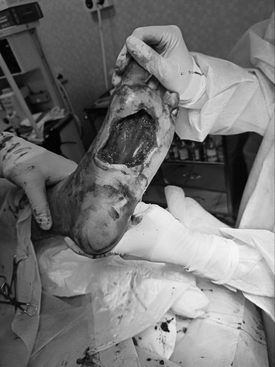 Подмосковье: врачи спасли ногу подростку после ДТП Подмосковье: врачи спасли ногу подростку после ДТП