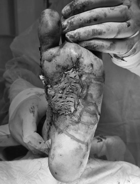 Подмосковье: врачи спасли ногу подростку после ДТП Подмосковье: врачи спасли ногу подростку после ДТП