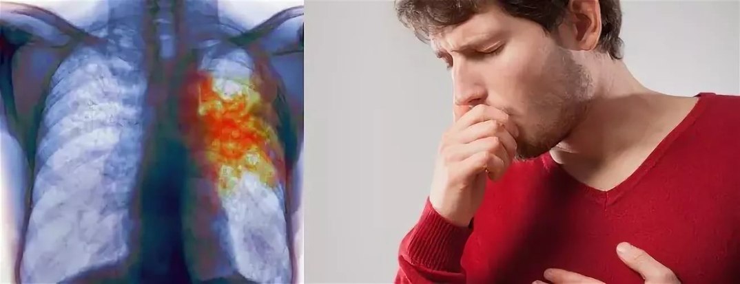 В России продолжается Неделя профилактики рака лёгкого