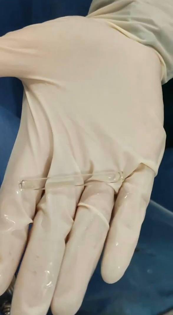 Пипетку из мочевого пузыря мужчины достали подмосковные врачи