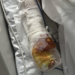 «Стойкий. Держится»: раненый после взрыва в Красногорске мальчик постоянно спит, у него сохраняется сильный болевой синдром, рассказала подмосковный детский омбудсмен Ксения Мишонова