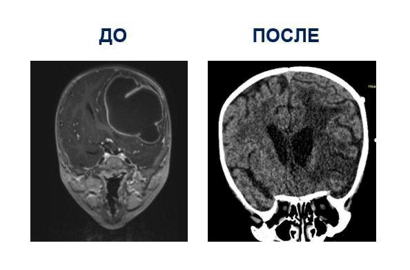 Нейрохирурги Центра Рошаля спасли двухлетнего мальчика с опасным абсцессом в голове Нейрохирурги Центра Рошаля спасли двухлетнего мальчика с опасным абсцессом в голове