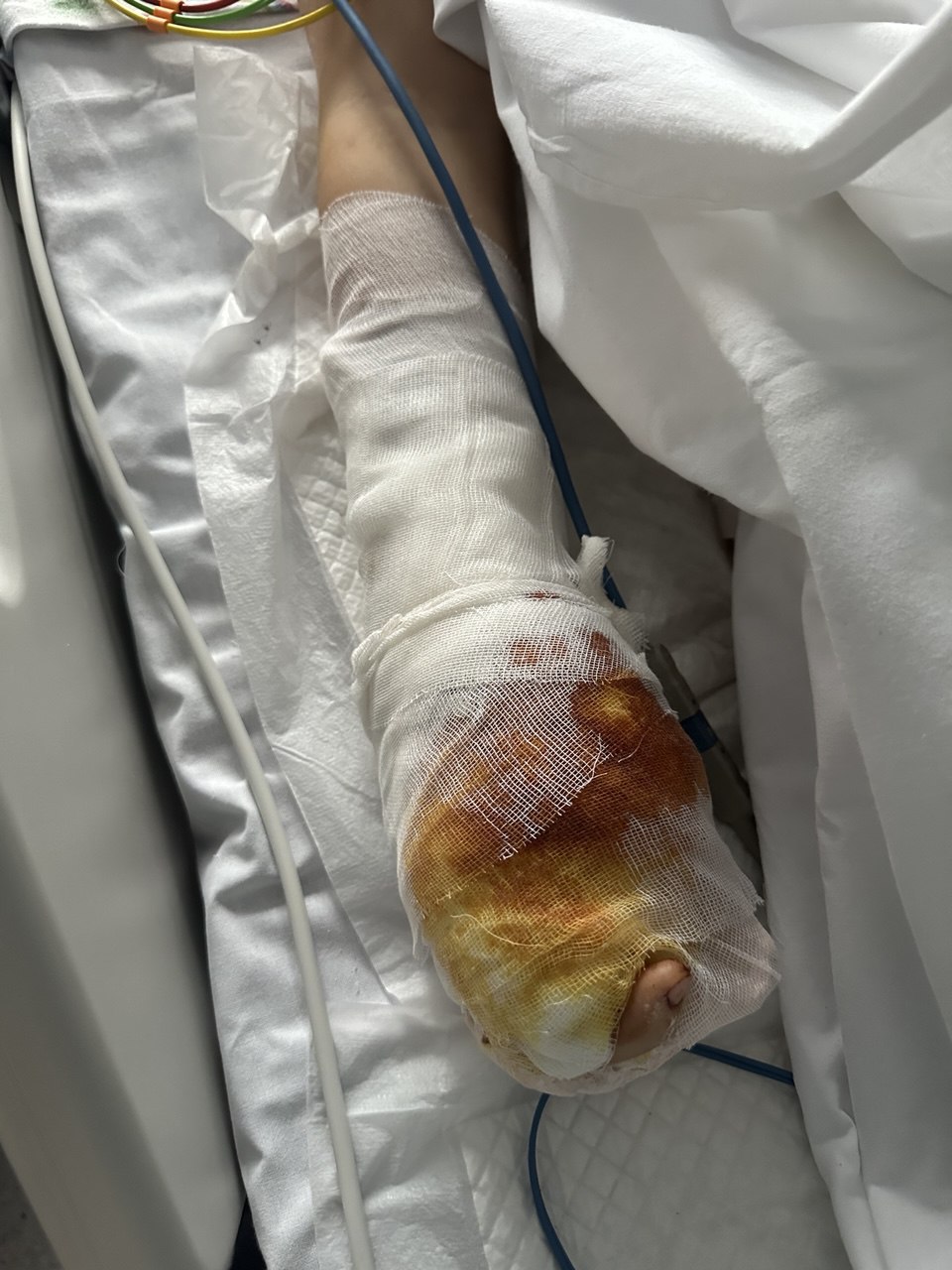 Так сейчас выглядит пострадавшая рука Глеба из Красногорска после операции — врачи держат мальчика под седацией из-за сильных болей