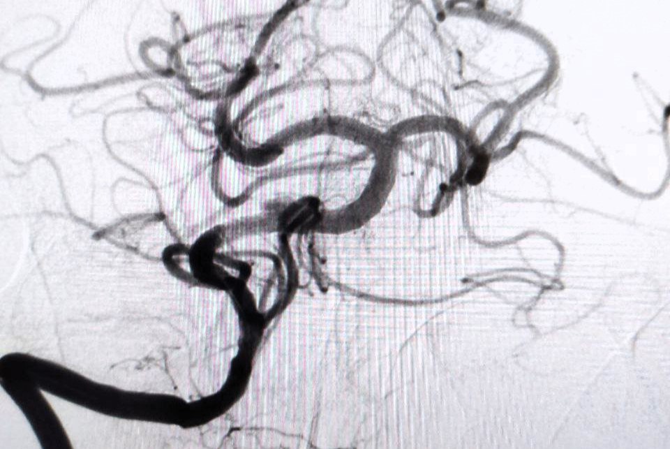 Врачи Мытищинского сосудистого центра спасли пациента с нетипичной картиной «ночного» инсульта Врачи Мытищинского сосудистого центра спасли пациента с нетипичной картиной «ночного» инсульта