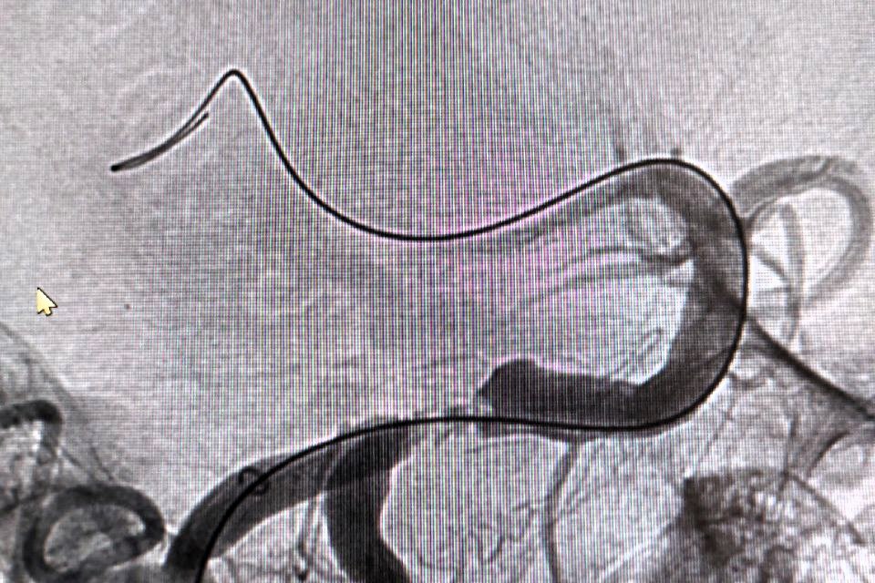 Врачи Мытищинского сосудистого центра спасли пациента с нетипичной картиной «ночного» инсульта Врачи Мытищинского сосудистого центра спасли пациента с нетипичной картиной «ночного» инсульта