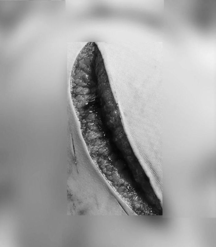 В Подмосковье врачи спасли девочку, которая врезалась в дверь и получила страшную рану ягодицы