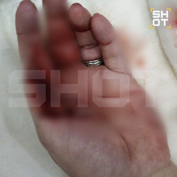 Акула покусала российскую туристку на Мальдивах — SHOT