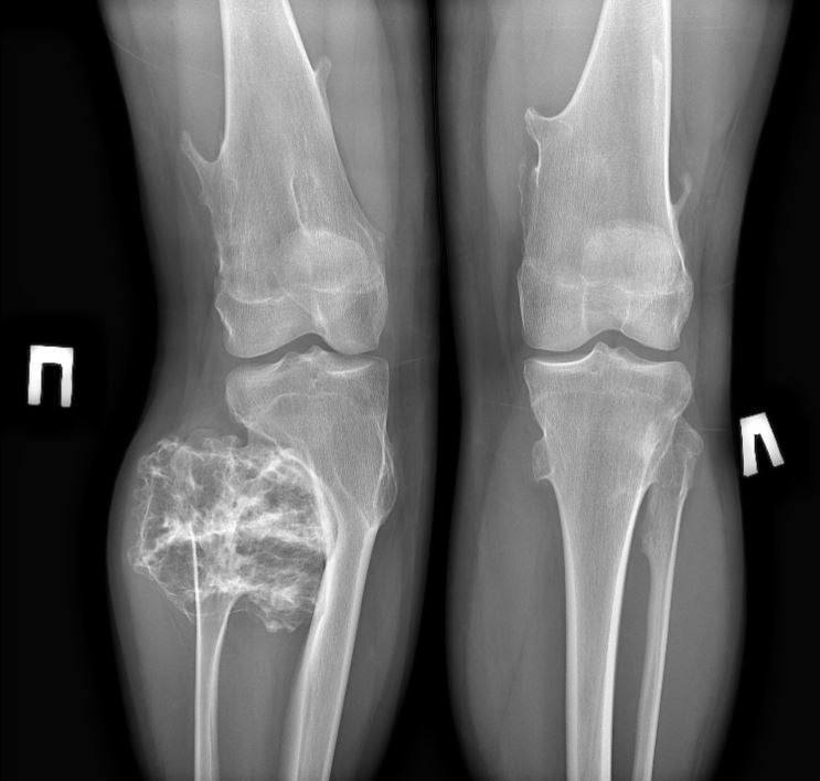 Подмосковные врачи удалили подростку крупную опухоль в ноге
