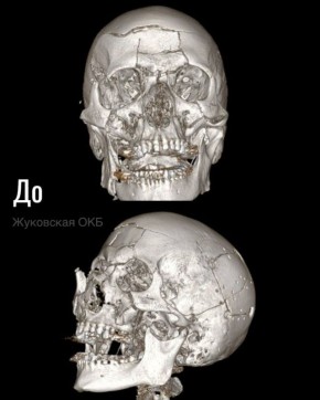 Жуковские хирурги выполнили сложную симультантную реконструктивную операцию пациенту после тяжёлой травмы