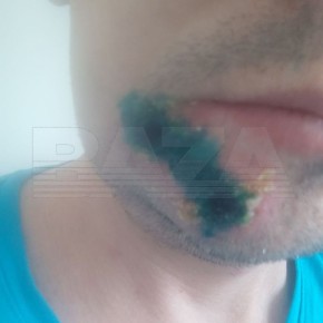 Оспа обезьян подтвердилась у одного из больных в Подмосковье — данные «Базы»