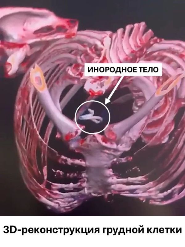 Королёвские врачи спасли пациента с инородным телом в лёгочной артерии Королёвские врачи спасли пациента с инородным телом в лёгочной артерии